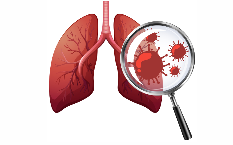 Pneumonia Doctor in Greater Noida